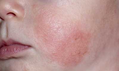 Аллергический дерматит у детей