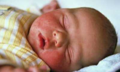 Дерматит у грудного ребенка