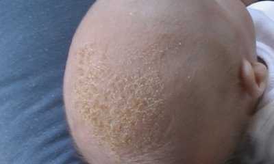 Детский дерматит на голове