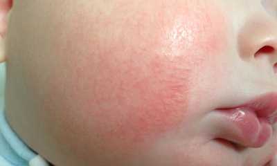 Как выглядит кожный дерматит