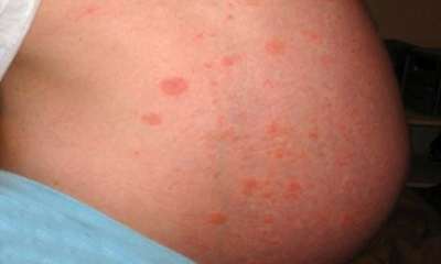 Аллергический дерматит у беременных