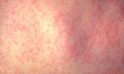 Аллергический дерматит у взрослых