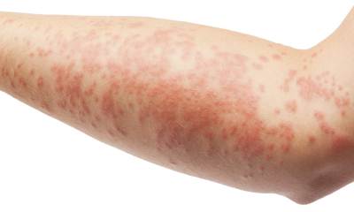 Атопический дерматит