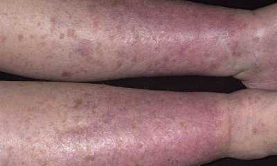 Варикозный дерматит