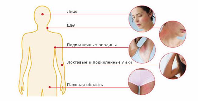 Виды дерматита