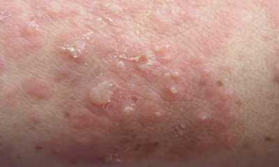 Герпетиформный дерматит