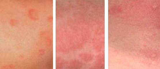 Дерматиты у взрослых