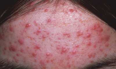 Инфекционный дерматит