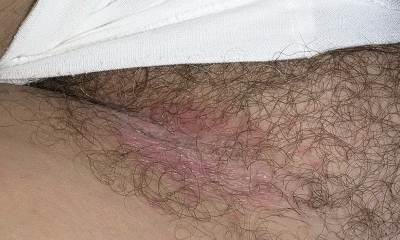 Паховый дерматит