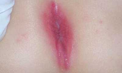 Перианальный дерматит