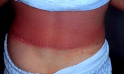 Солнечный дерматит