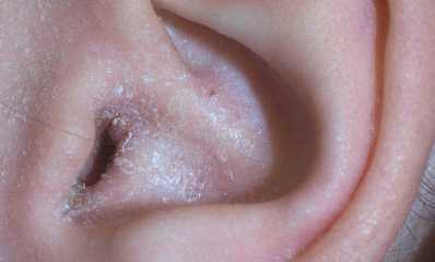 Ушной дерматит