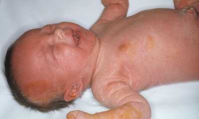 Эксфолиативный дерматит