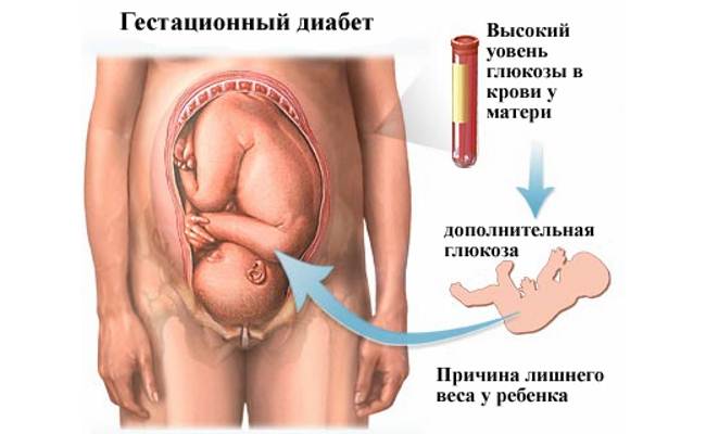 Гестационный сахарный диабет