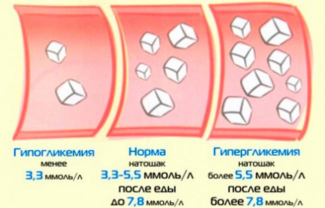 Декомпенсированный сахарный диабет