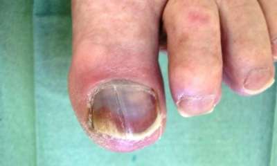 Ногти при сахарном диабете