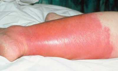 Покраснение ноги при сахарном диабете
