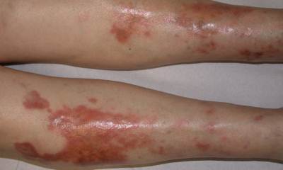 Пятна на ногах при сахарном диабете