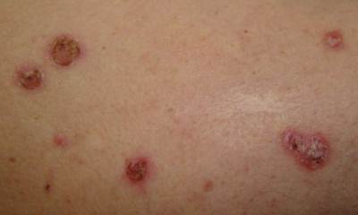 Симптомы сахарного диабета