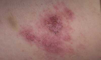 Сыпь при сахарном диабете