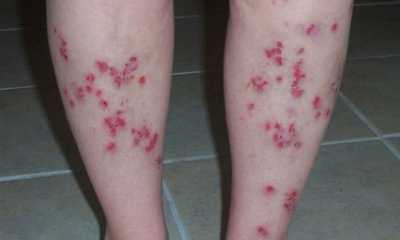 Язвы на ногах при сахарном диабете