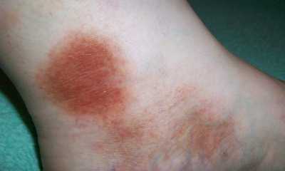 Кожа при сахарном диабете