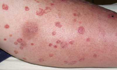 Признаки диабета на коже