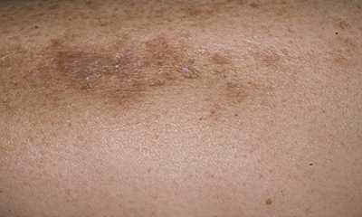 Признаки сахарного диабета у женщин