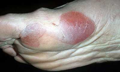 Признаки сахарного диабета у мужчин