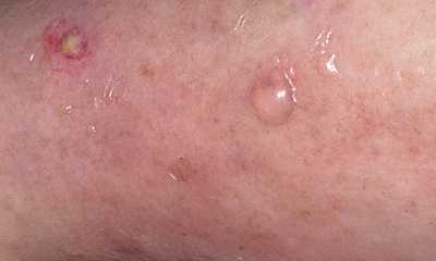 Сахарный диабет у детей