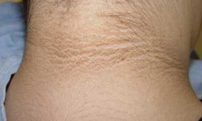 Сахарный диабет у женщин