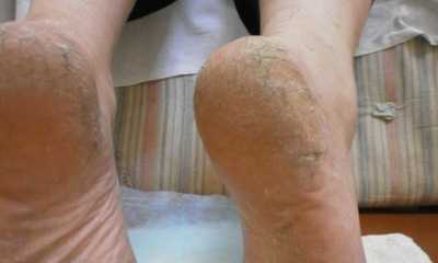 Сахарный диабет у мужчин