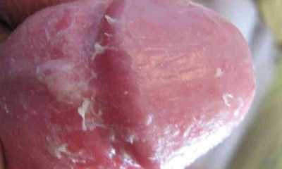 Молочница у мужчин на головке