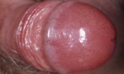 Мужская молочница