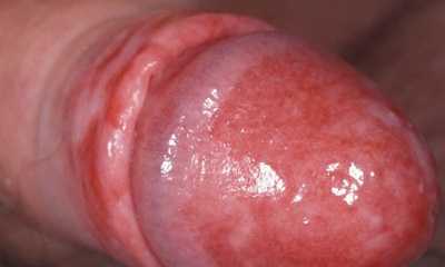 Первые признаки молочницы у мужчин