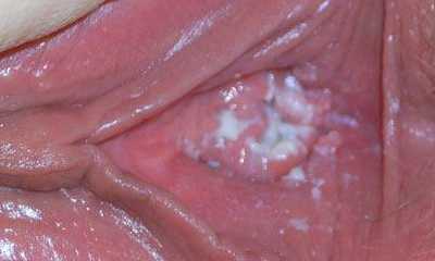 Выделения при молочнице у женщин