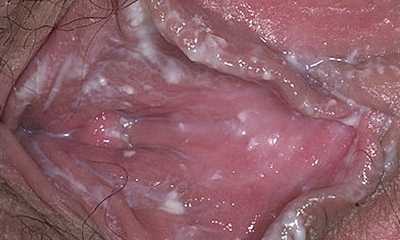 Как проявляется молочница у женщин