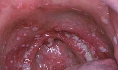 Молочница в горле