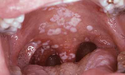 Молочница во рту у взрослых