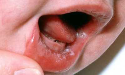 Молочница во рту у детей