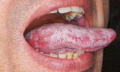 Молочница на языке