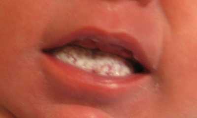 Молочница у новорожденных во рту