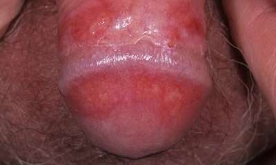 Генитальный кандидоз у мужчин