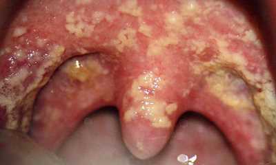 Кандидоз у женщин во рту