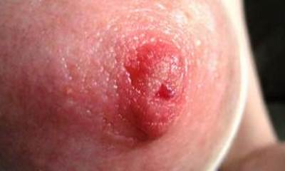 Молочница на грудных железах