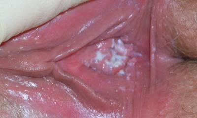 Молочница у беременных женщин