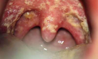 Орофарингеальный кандидоз