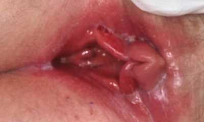 Признаки кандидоза у женщин