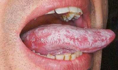 Симптомы кандидоза у мужчин