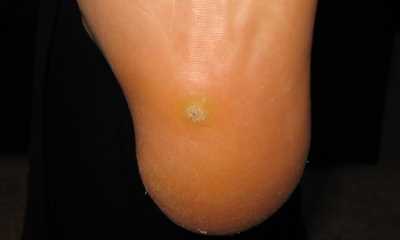 Как выглядит пяточная шпора